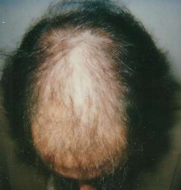 Hair Loss Causes Diet For Diabetics